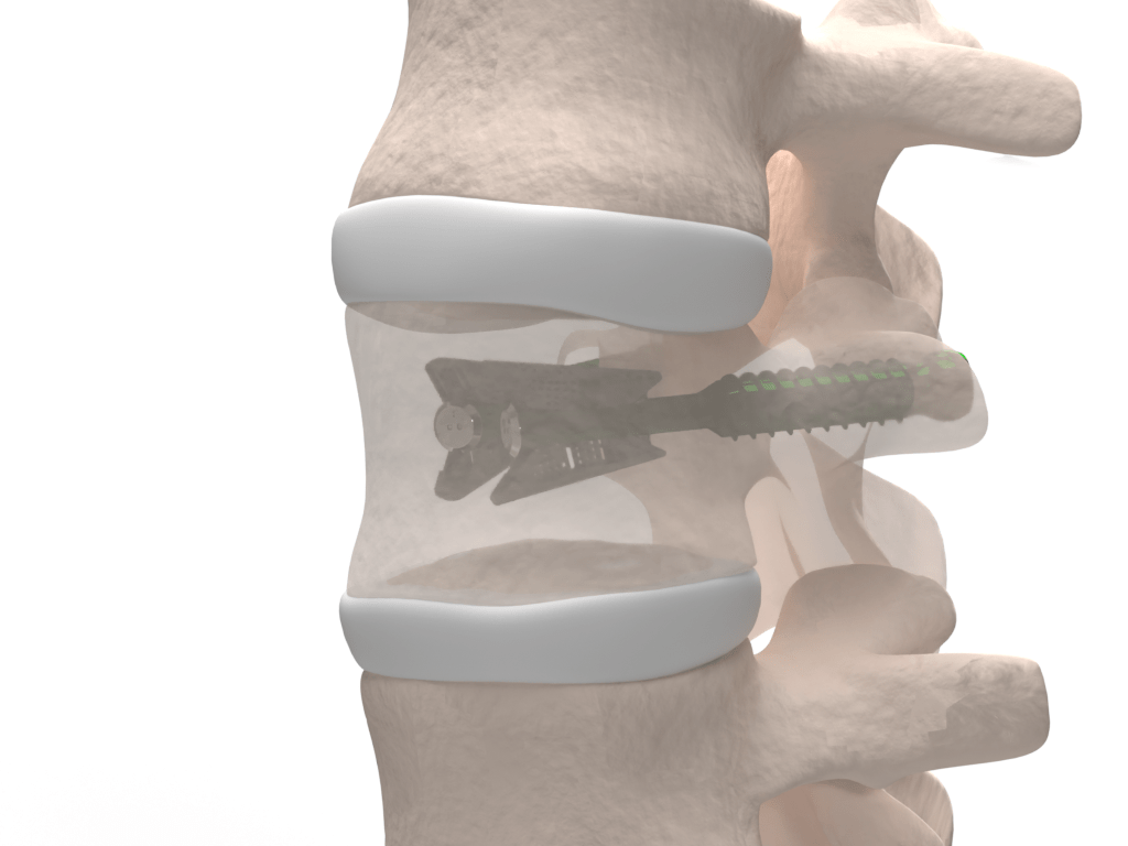 VCFix® implant cementless