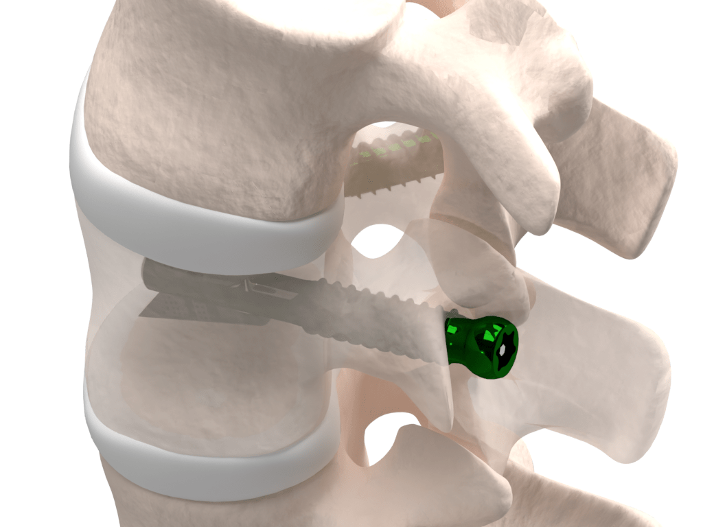 VCFix® implant with pedicle fixation