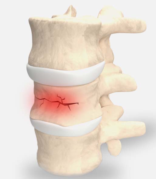 Vertebral Compression Fracture