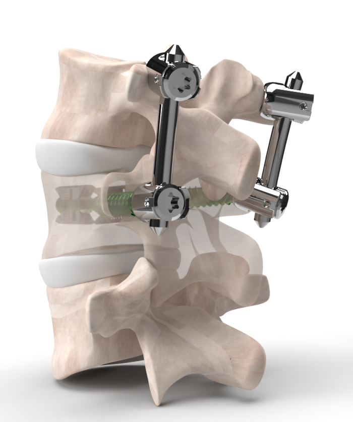 VCFix® implant compatible with posterior fixation