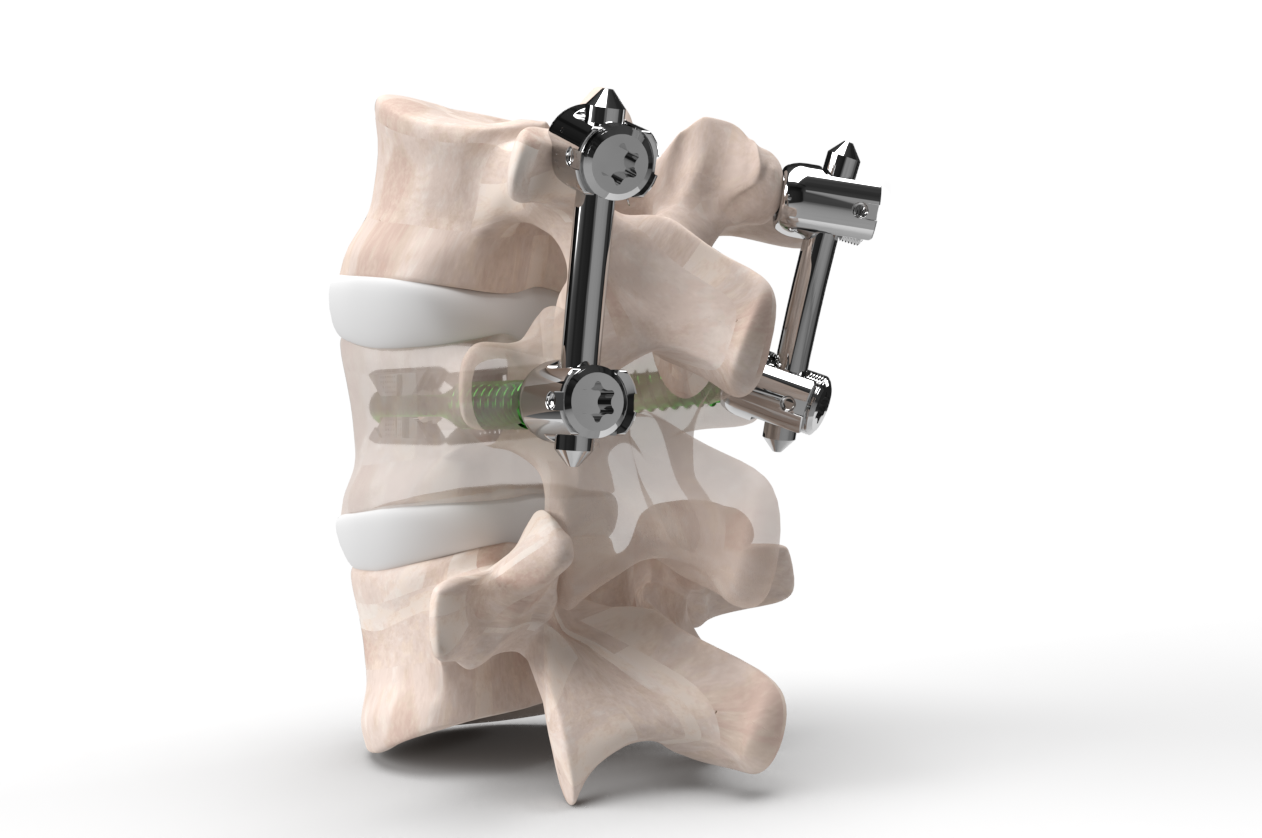 VCFix® implant compatible with posterior fixation